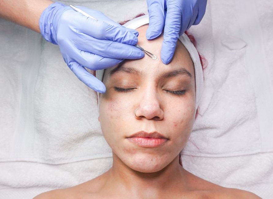 1. Combate a acne na raiz